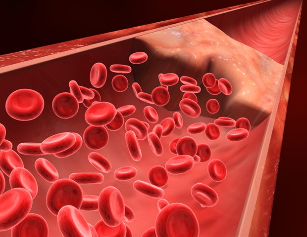 Common oral anticoagulant rivaroxaban linked to highest risk of bleeding complications