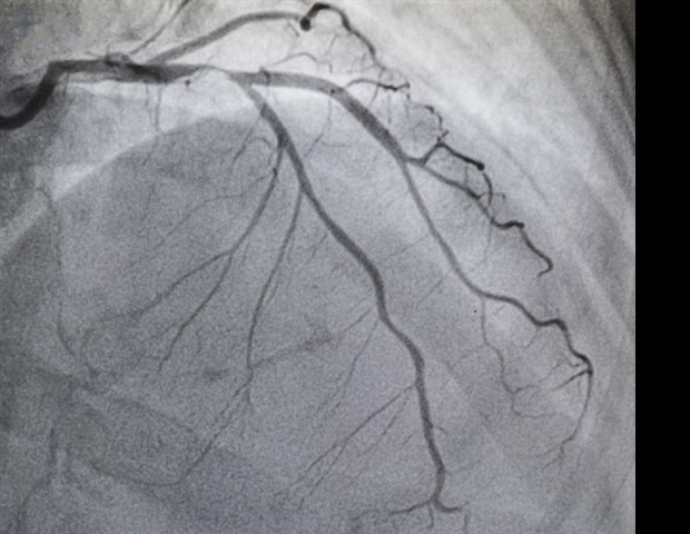 Study shows radial arterial access superiority in coronary interventions