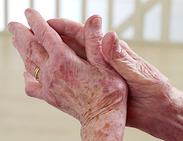 Study shows high burden of arthritis symptoms in patients people with psoriasis