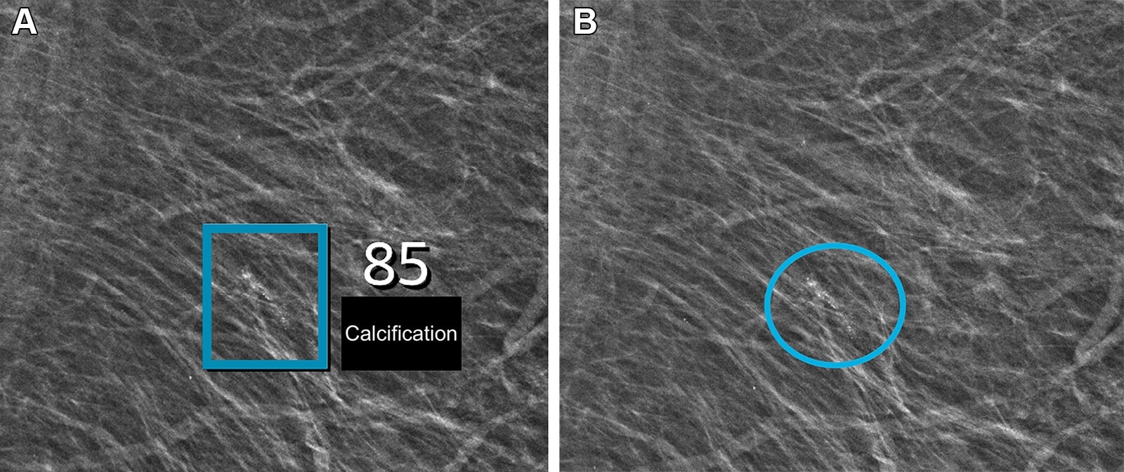 Left mediolateral oblique full-field digital mammographic view in a 67-year-old woman with a Breast Imaging Reporting and Data System density of 1 who underwent screening with the artificial intelligence (AI) system. (A) Image shows AI-provided marking (square). The screening received a high AI examination score of 10, based on this area with arterial calcifications being given a score of 85 out of 100 by the AI system. (B) Same image as in A, but with findings by the radiologists. Because of the high AI examination score, the screening was double read by two radiologists, who determined that the arterial calcifications (circle) did not yield suspicions for breast cancer. The woman was not recalled for diagnostic assessment.